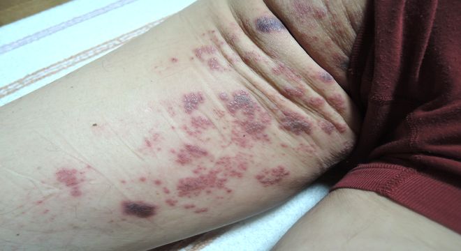 帯状疱疹の初期症状（画像）