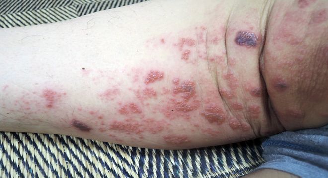 帯状疱疹（赤い斑点）